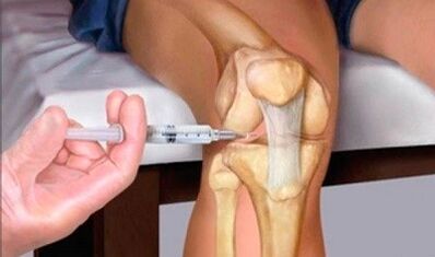 Hyaluronic acid with arthrosis of the knee joint