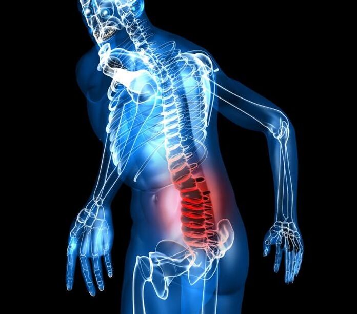stages of scale and development of lumbar osteochondrosis