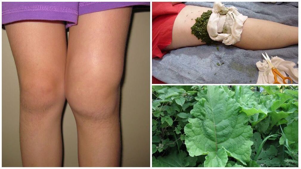 Compress on the knee with burdock - a popular method for treating gonarthrosis