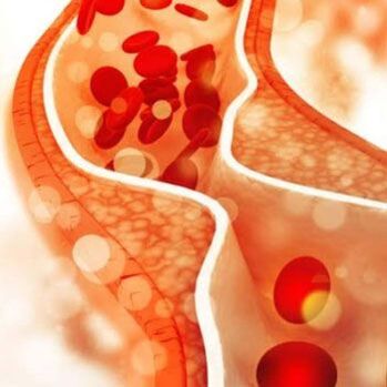Cholesterol deposition on the inner walls of blood vessels provokes pain on the side of the neck